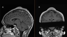 two mri images of a person's head shown facing the side and then the back. A large lump can be seen on top of the skull from both angles